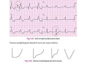 According To Previous Post Of How To Dx Rbbb ,this Ecg Of - Medizzy