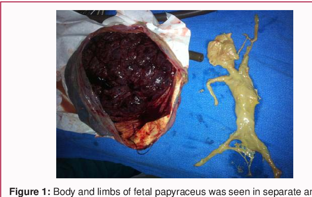 Fetal Papyraceus