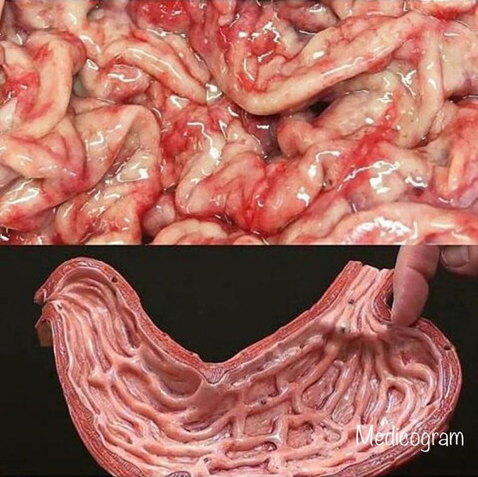 Picture depicting a Stomach model vs the real stomach