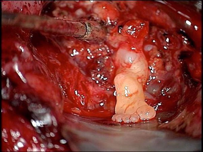 Foot Growing… in the Brain
