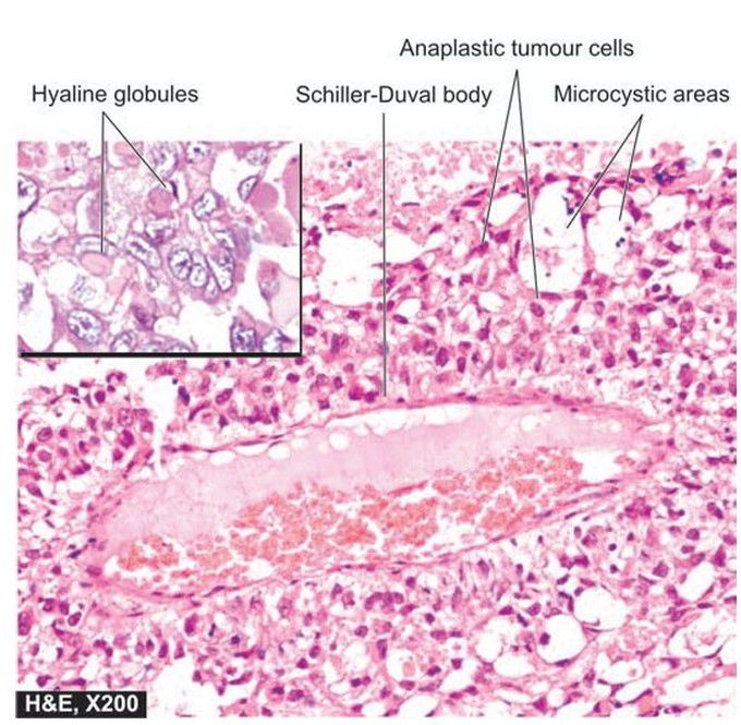 Endodermal sinus (yolk sac) tumour ovary.