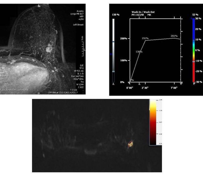 Advanced breast MR Imaging!