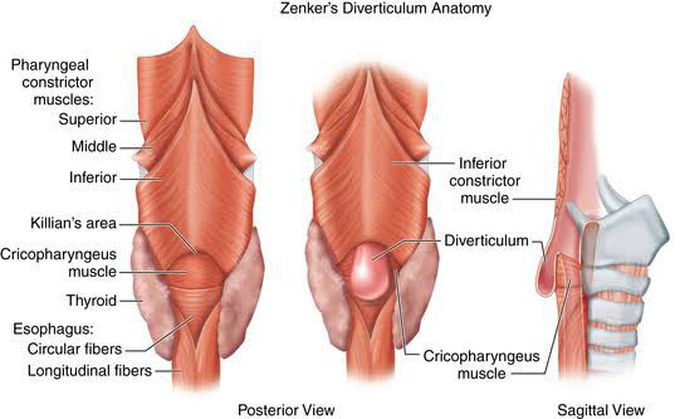Zenker's Diverticulum Anatomy