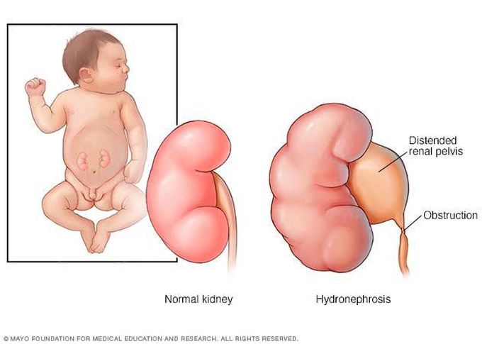Treatment of hydronephrosis