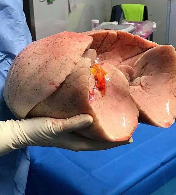 Hermoso par de pulmones antes del trasplante.