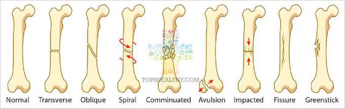 Types of fracture