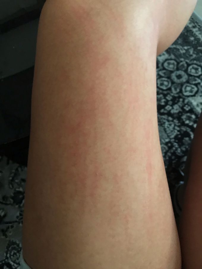 Allergic to Sweat
