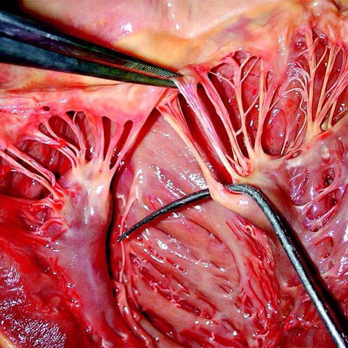 Ruptured mitral valve Chordae Tendineae due to bacterial Endocarditis