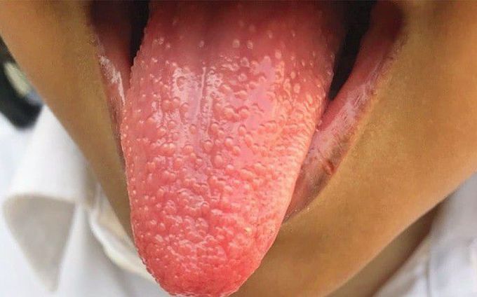 Streptococcal pharyngitis