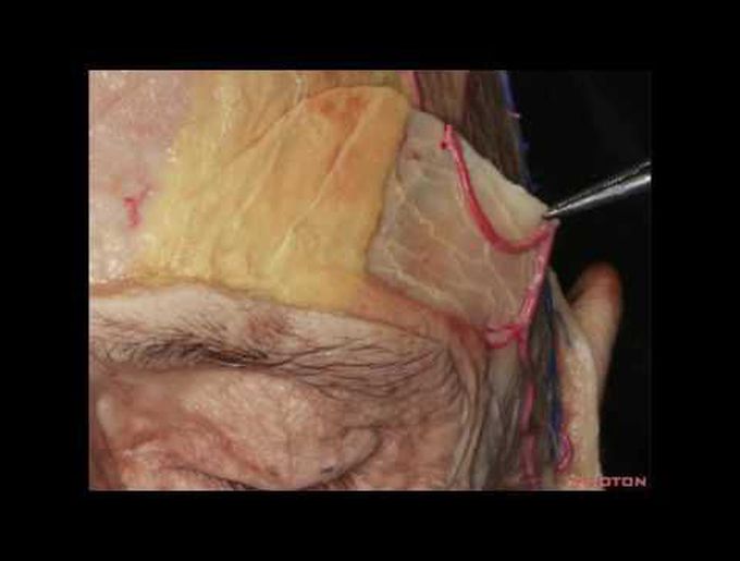 Preserving the Frontalis Muscle
