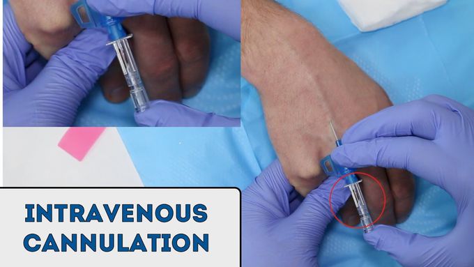 Intravenous (IV) cannulation - OSCE Guide