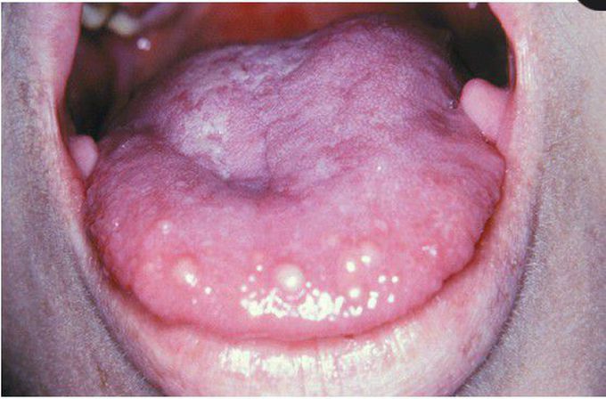 Multiple Endocrine Neoplasia (MEN) Type 2B.