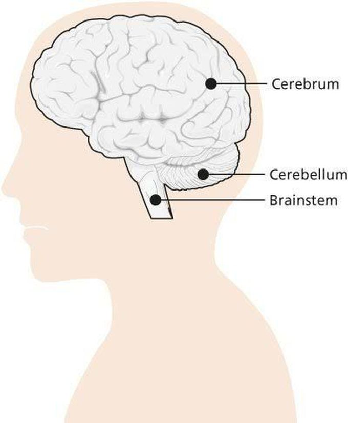 Brain stem death