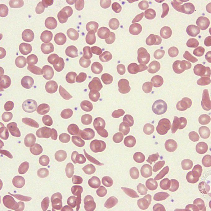 Sickle cell anemia