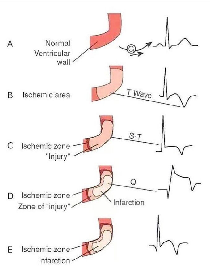 Learning ECG Waves