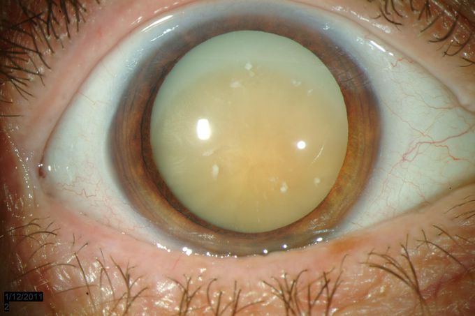 Symptoms of Cataract