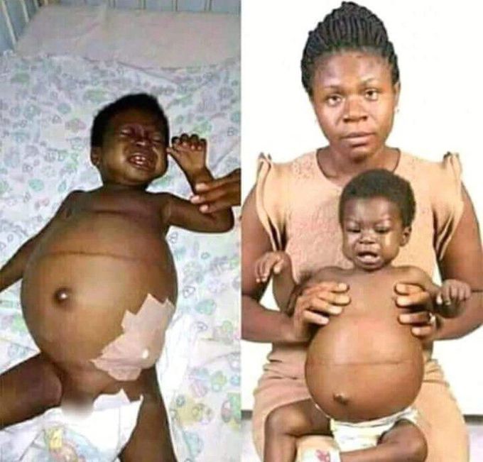 Swollen abdomen