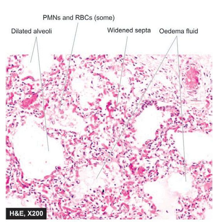 Lobar pneumonia