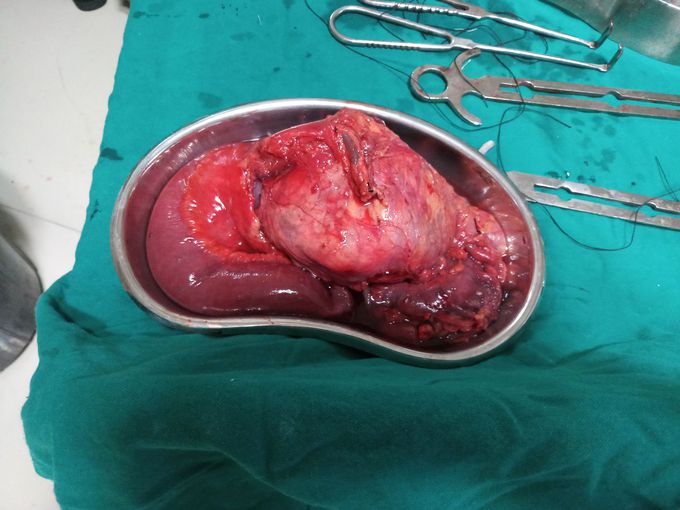 A case presented with the abdominal pain on the right lower quadrant along with difficulty in passing stools since 1 year on examination anemia was present and a mass of about 5×7 cm could be felt in the right upper and lower quadrant and tenderness was also present. This is the picture of the specimen that i took after the surgery what could be the diagnosis and name of the procedure that has been done?