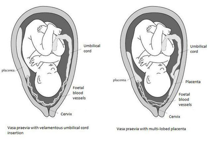 Symptoms of vasa previa - MEDizzy