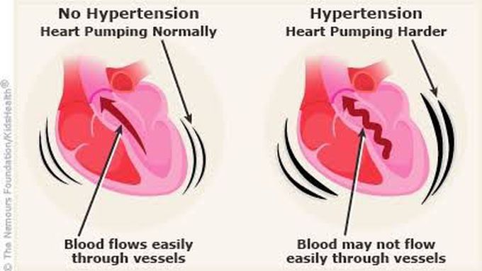 Hypertension