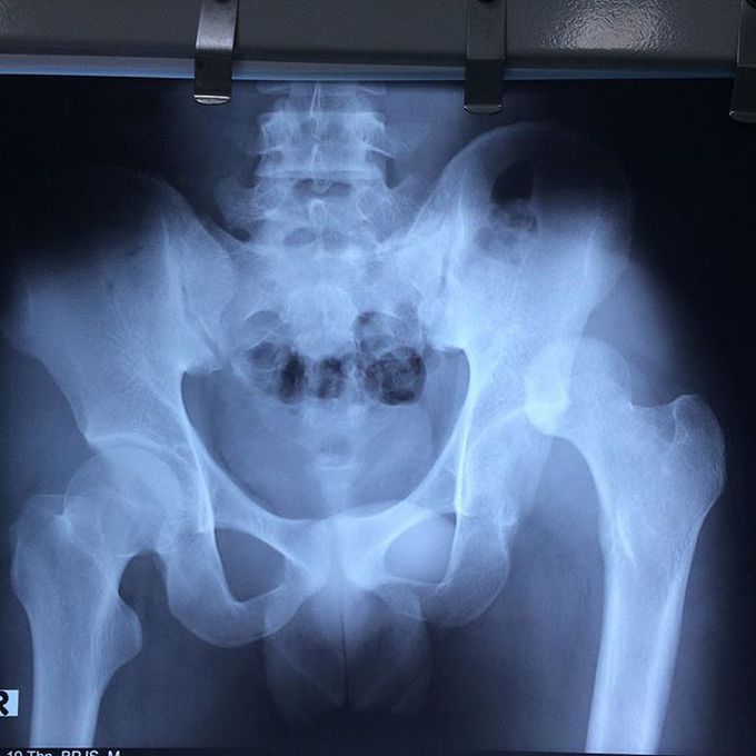 Neglected posterior dislocation of the hip