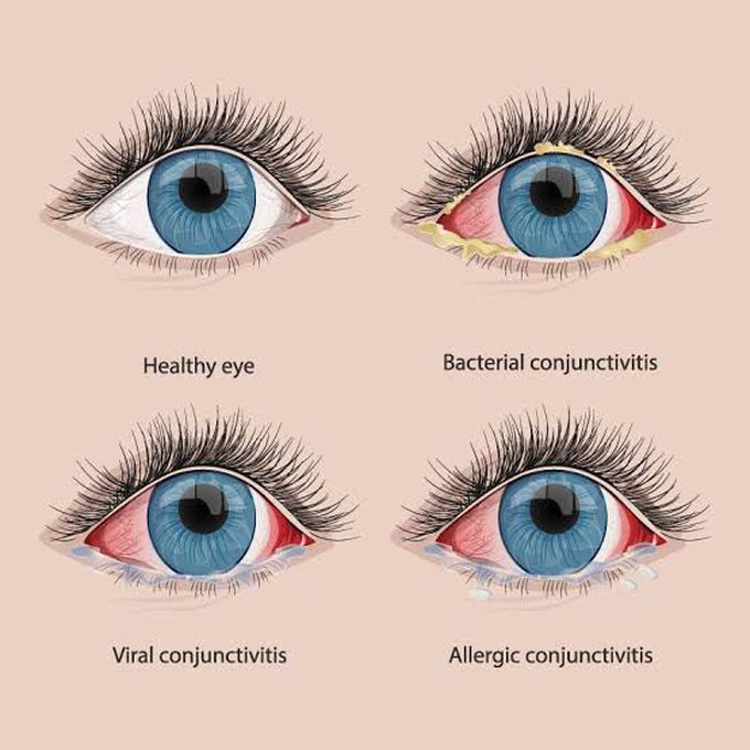 Causes of conjunctivitis
