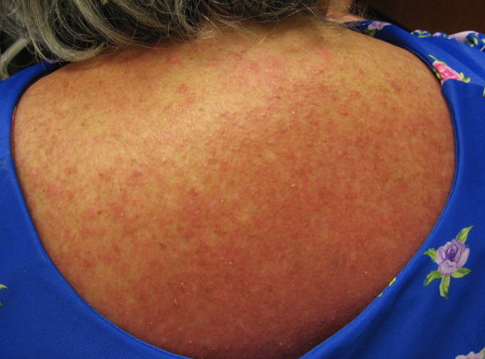 Clozapine-Induced DRESS Syndrome in 32-Year-Old