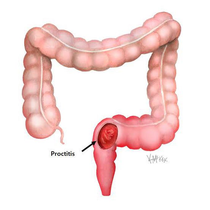 Proctitis