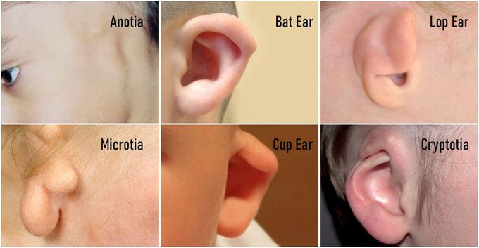 Developmental disorders of the ear - medizzy