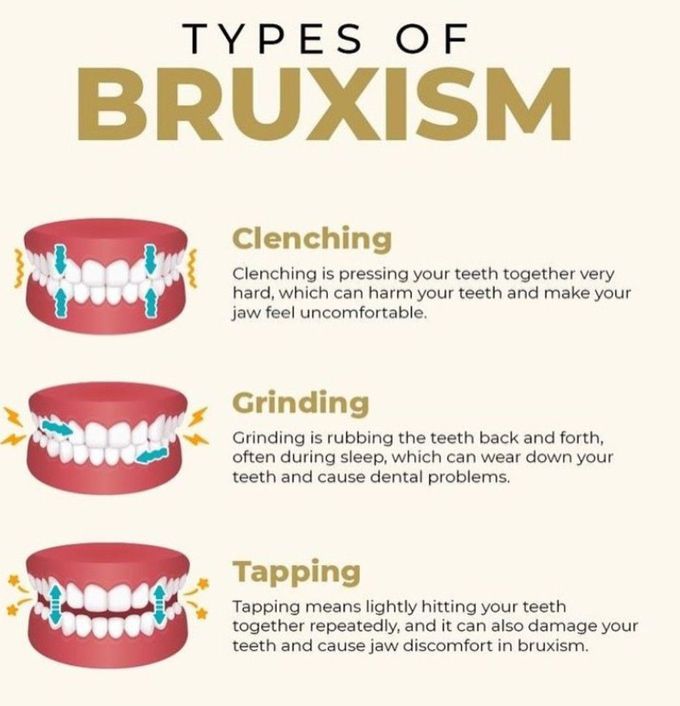 Types of Bruxism