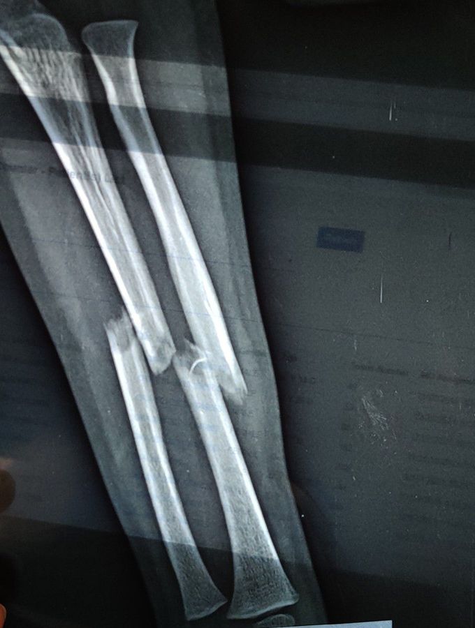 Radius + Ulna Fracture