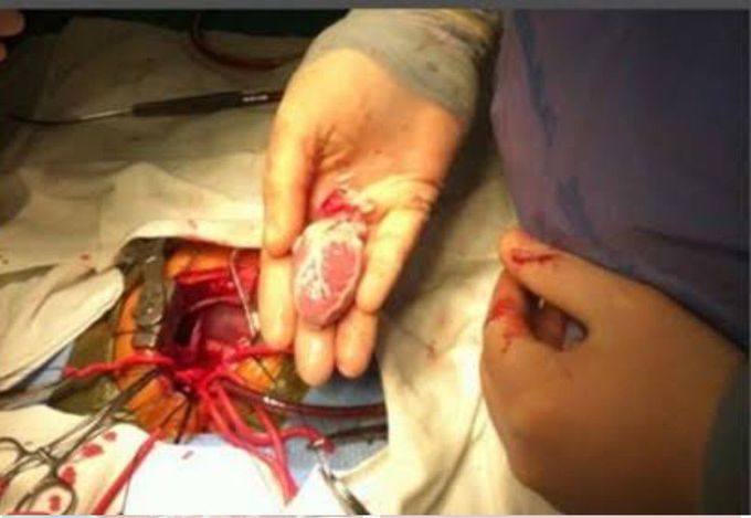 Pediatrics Heart transplant
