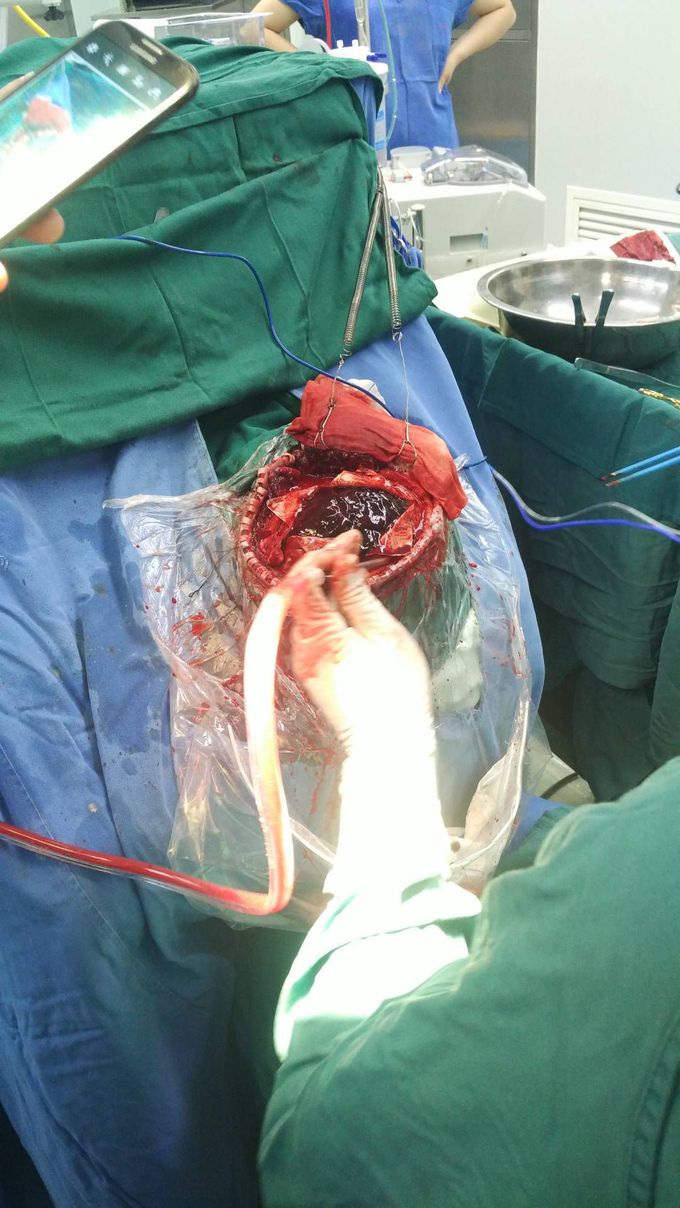 Subdural hematoma 