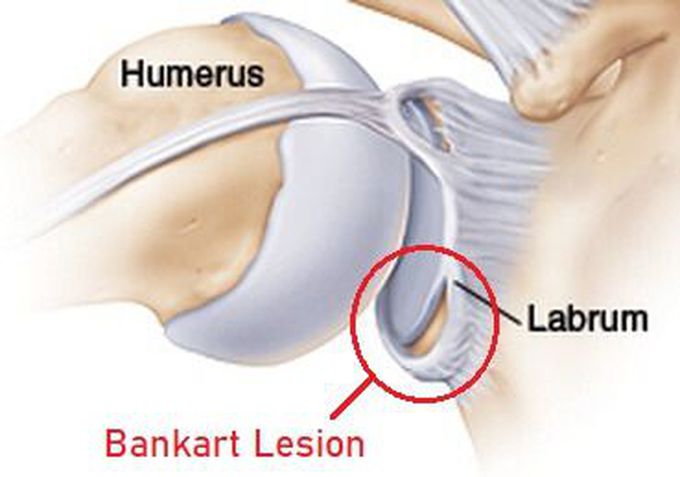 Bankart Lesion