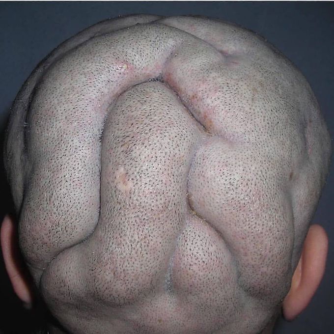 Cutis verticis gyrata (CVG)