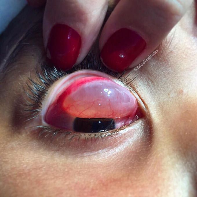 Giant conjunctival inclusion cyst bulging from underneath! 