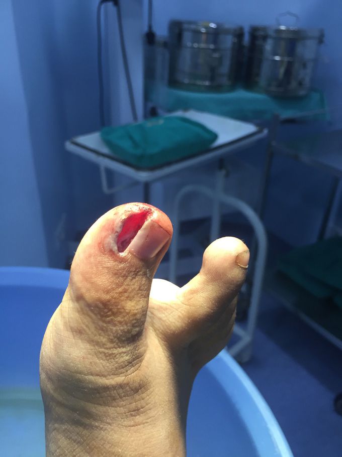 After toe nail ingrown surgery