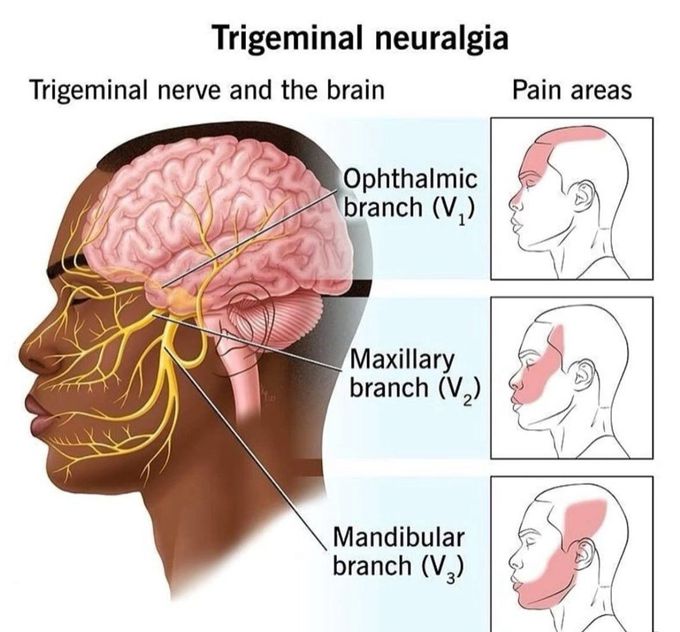 Trigeminal Neuralgia