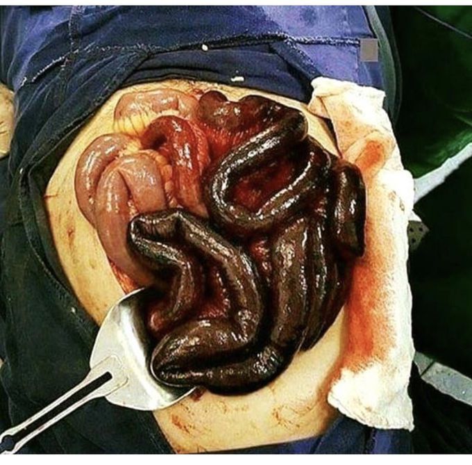 Mesenteric ischemia