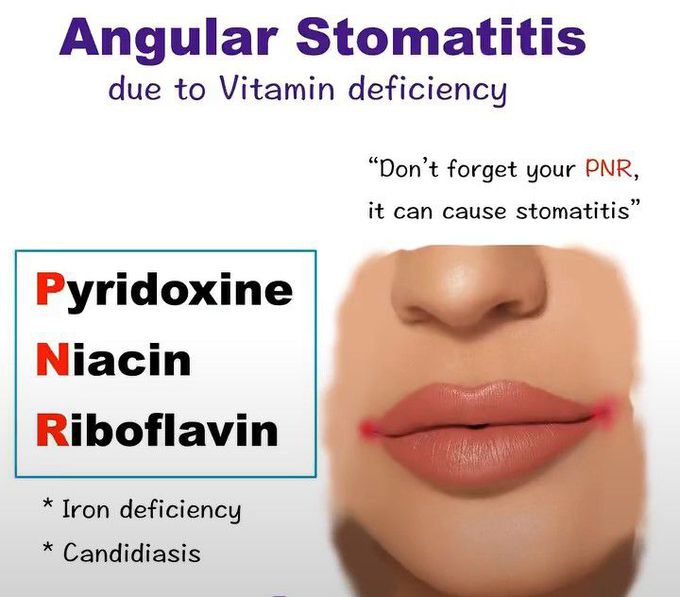 Angular Stomatitis