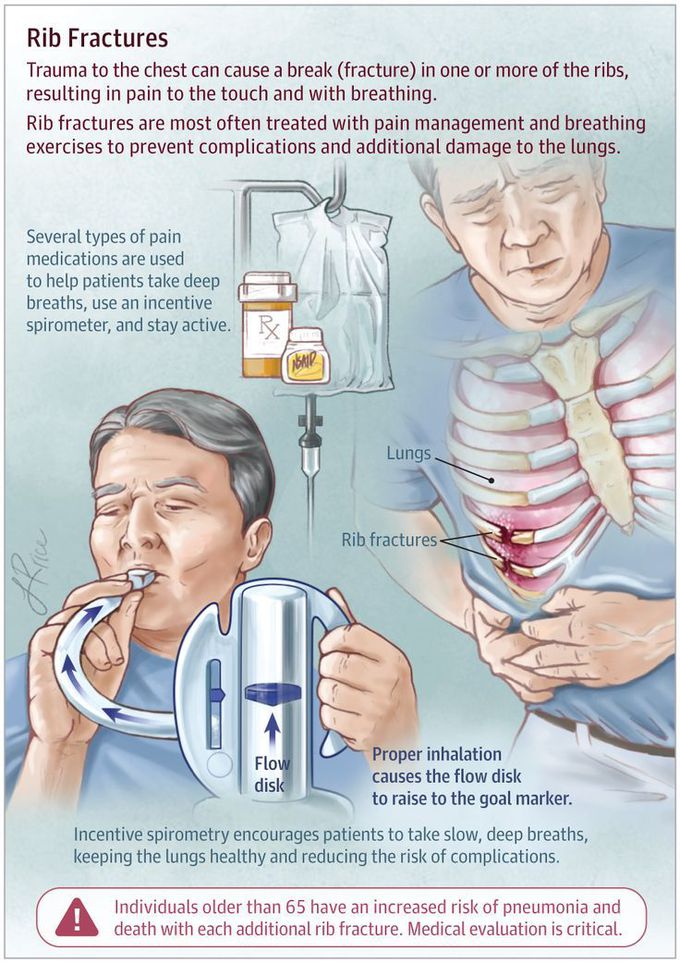 This JAMA Patient Page describes the symptoms and treatment of rib fractures. | Pharmacology nursing, Medical education, Medical knowledge
