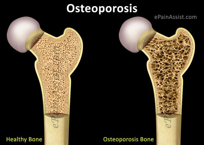 Osteoporosis General Intro....
