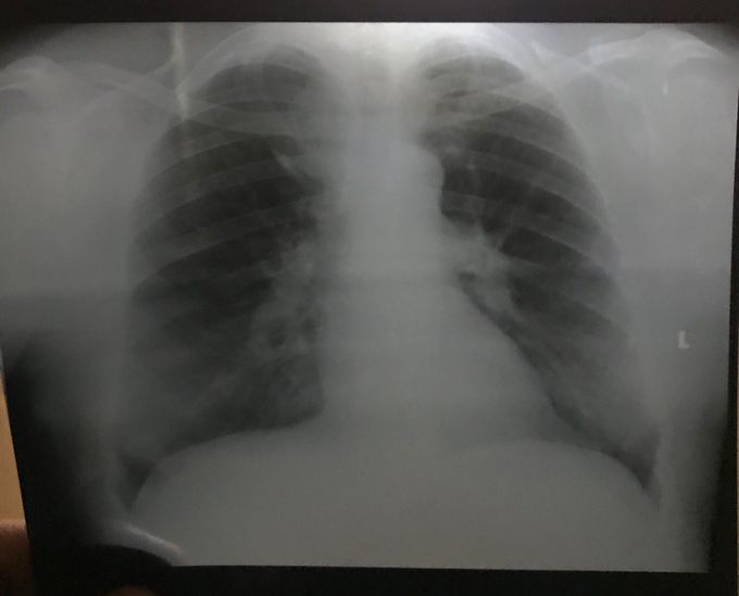 Lungs