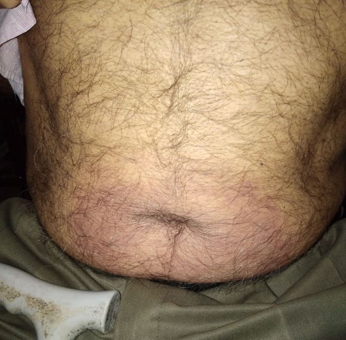 Rare case of insulin reaction