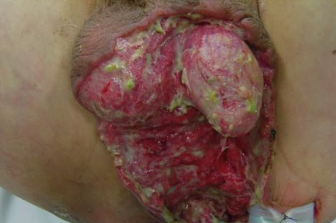 45 year old male, known case of diabetes melitus type 2, presented with c/c ulcers on perineum and scrotal skin since 3 weeks. Gradual onset, progressive and mild pain, associated with fever with rigors and pus discharge since last 4 days. He was diagnosed diabetic 4 years back and his diabetes is poorly controlled. No history of HTN, asthma, tuberculosis or allergy. He's diabetic (type 2), occasional smoker and alcoholic. On examination, tachycardia present and patient is febrile. Local examination reveals decreased pain sensation on the affected area and also have perepheral neuropathy. Multiple pus points seen on the ulcer.