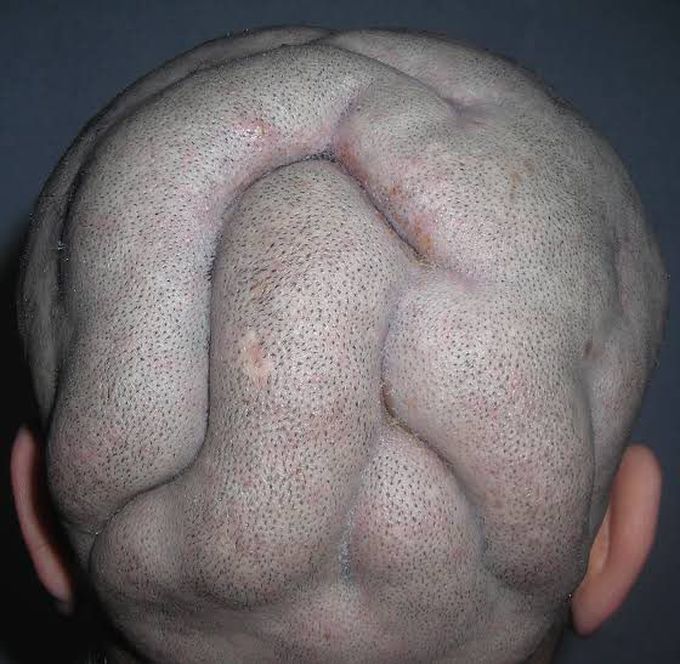 Cutis verticis gyrata