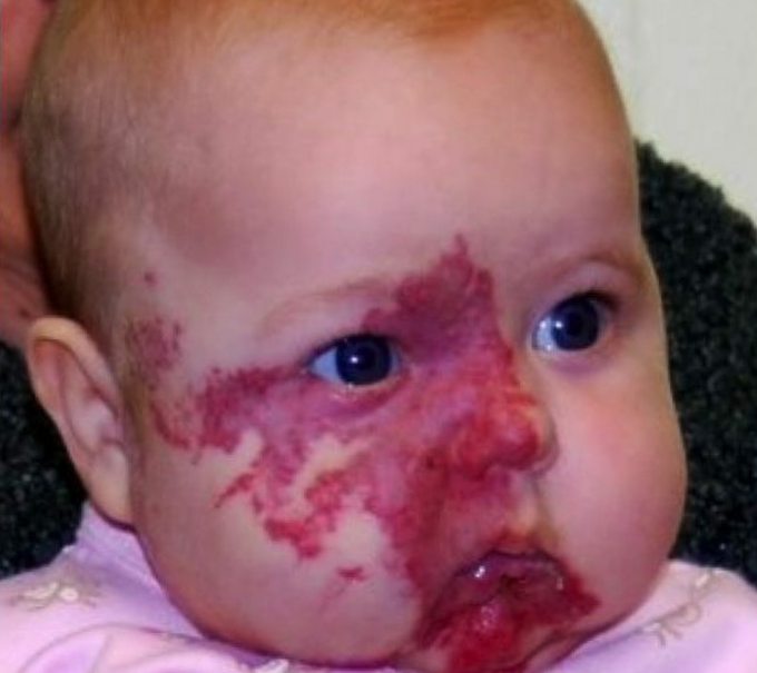 Sturge-weber syndrome
