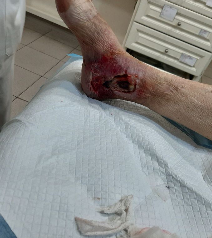 Diabetic foot