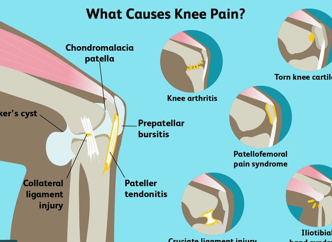 Causes of knee pain